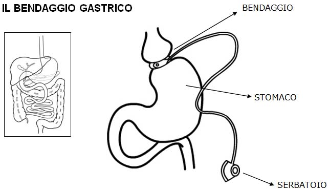 bendaggio gastrico