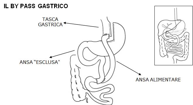bypass gastrico