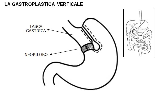 gastroplastica verticale