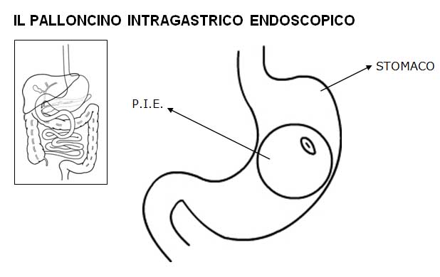 palloncino intragastrico endoscopico