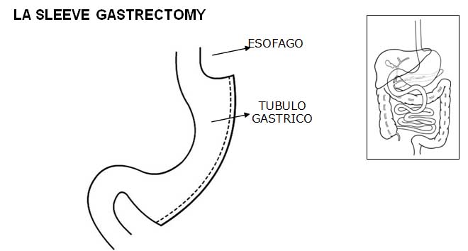 sleeve gastrectomy